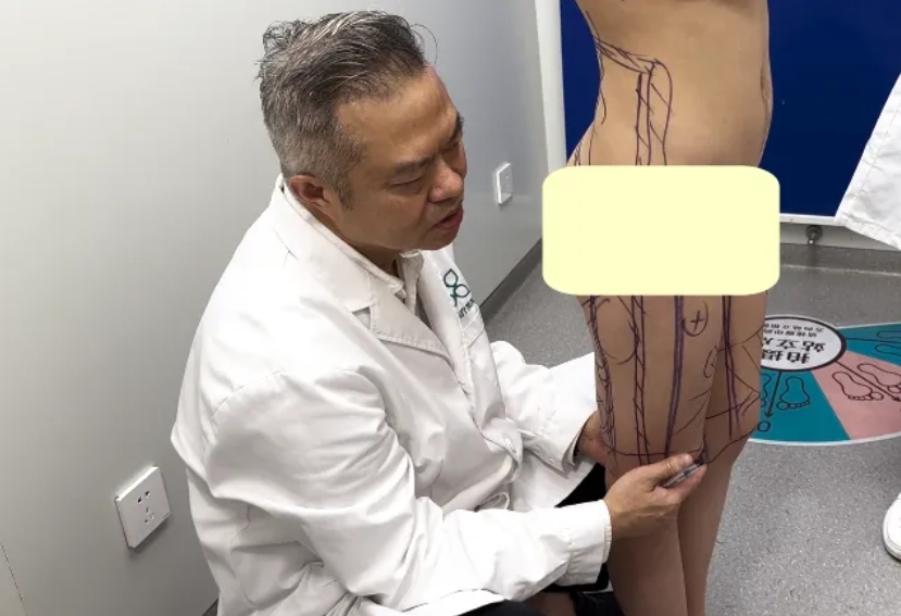 大腿吸脂前后效果图片