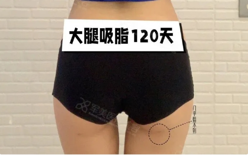 手臂吸脂