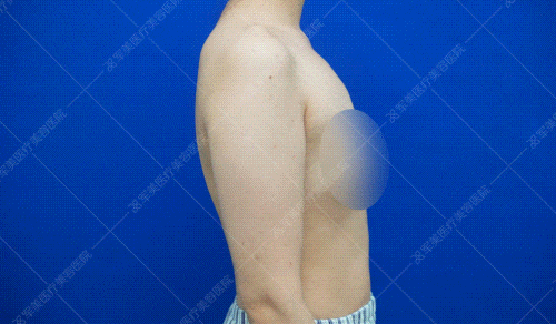 手臂吸脂案例
