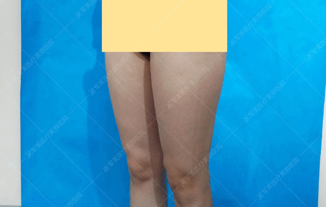 王世虎大腿吸脂