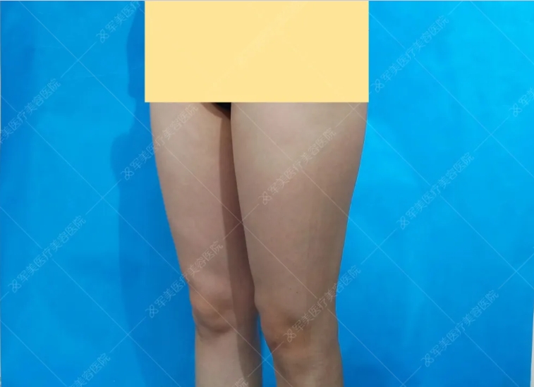 大腿吸脂手术多久可以恢复