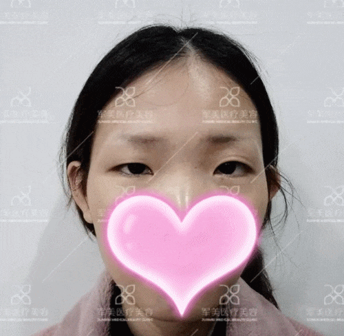 大小眼睛怎么矫正