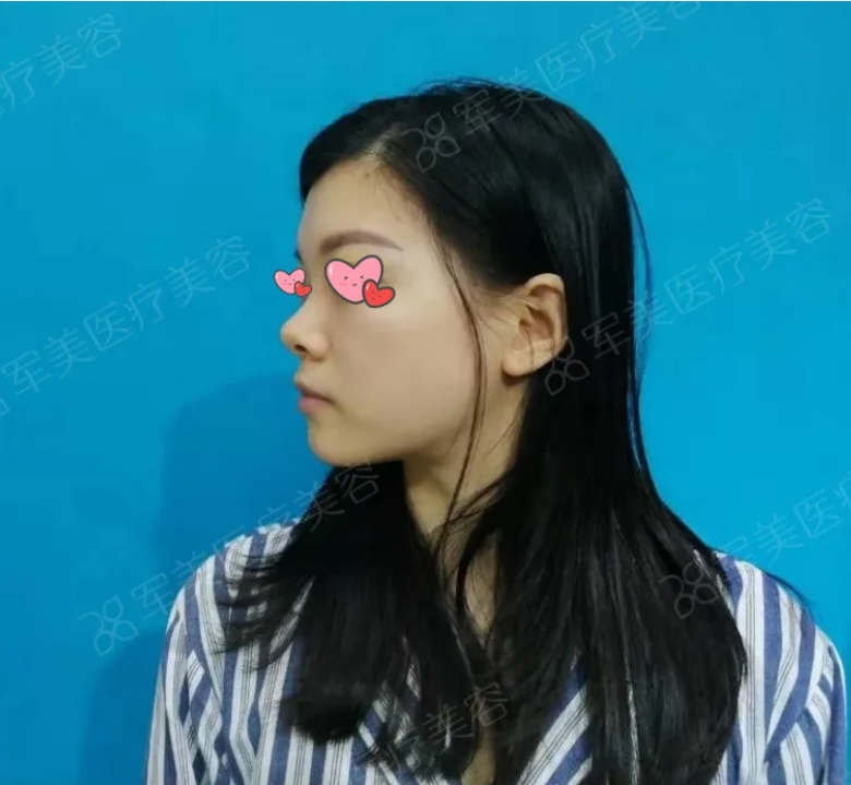 膨体鼻综合
