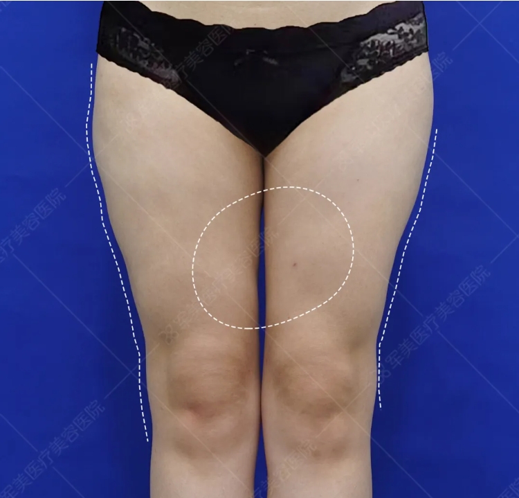 广州大腿吸脂失败修复医院哪家好