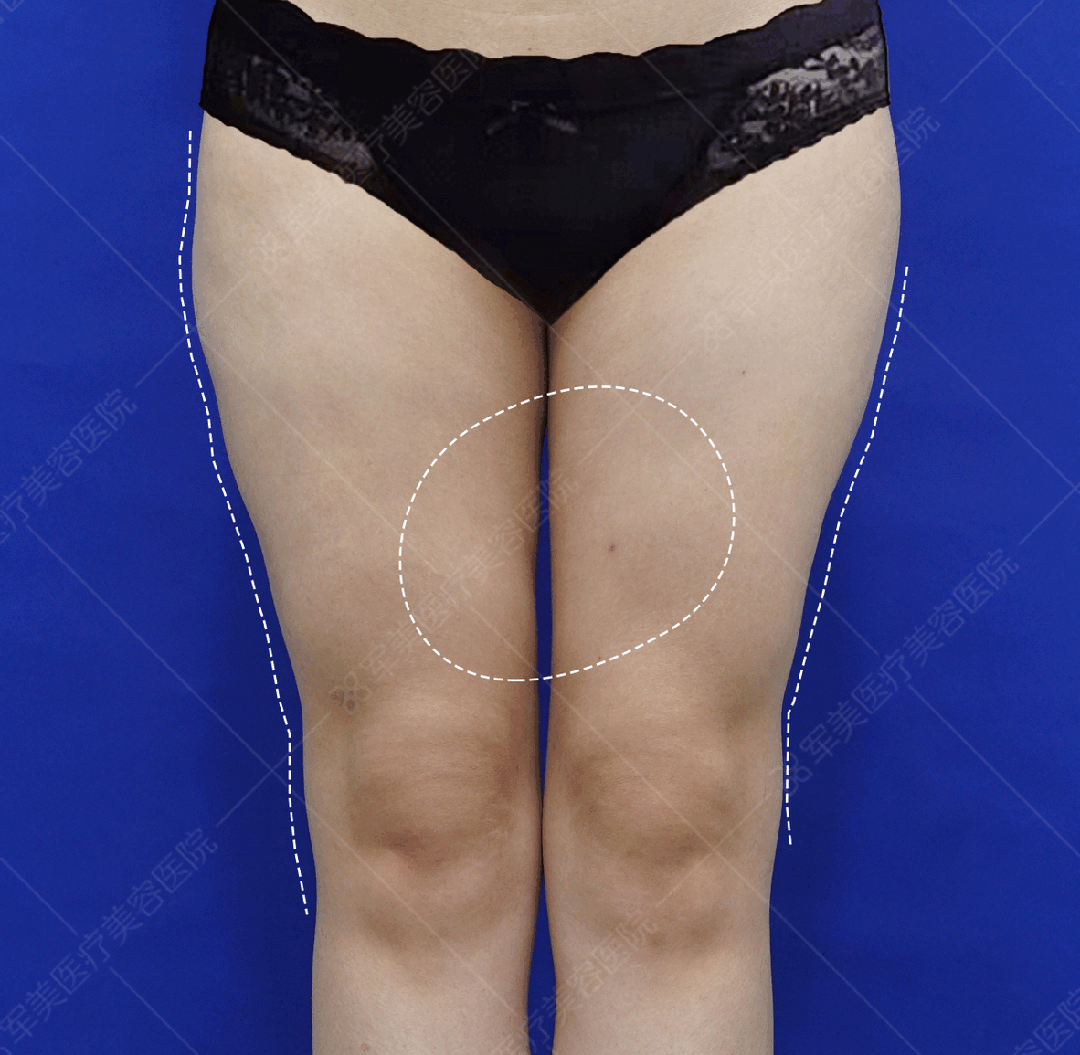 王世虎大腿吸脂修复