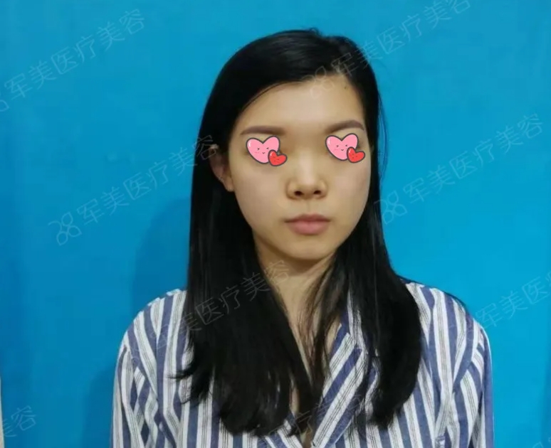 半肋软骨鼻综合