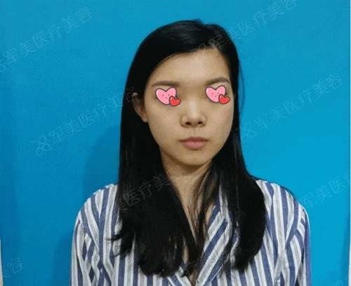 膨体鼻综合
