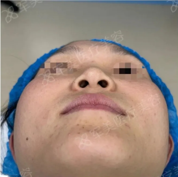 鼻头肥大怎么改善