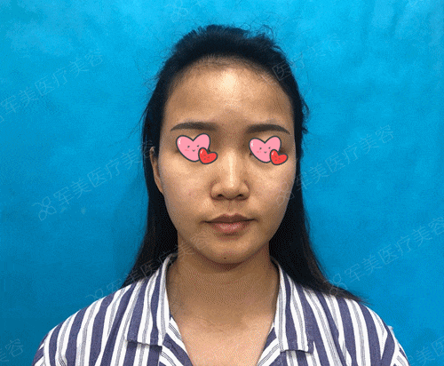 半肋鼻综合案例