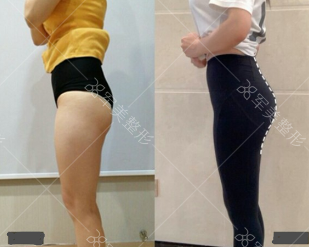 自体脂肪丰臀存活率高吗