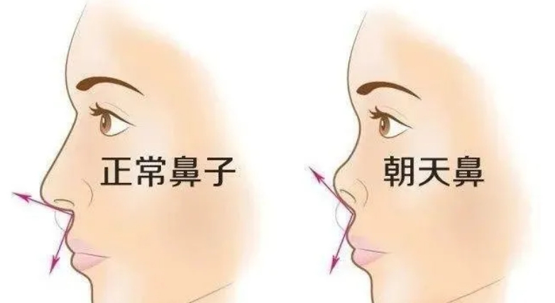 朝天鼻怎么改善