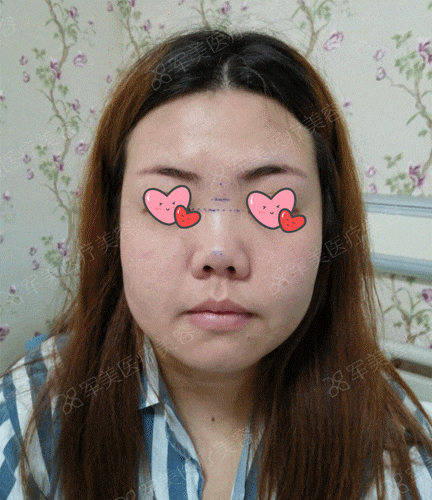 鼻唇角过大