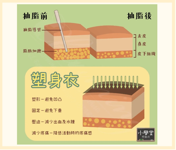 吸脂术后塑身衣要穿多久