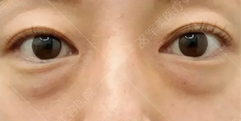 眼袋手术哪家医院做的好