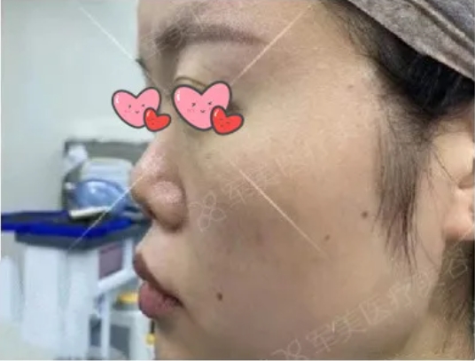 朝天鼻怎么改善