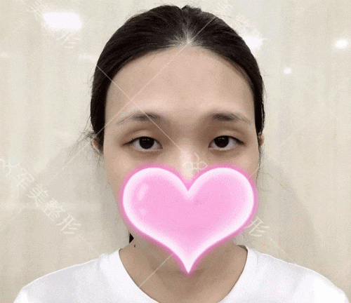 单眼皮怎么变成双眼皮