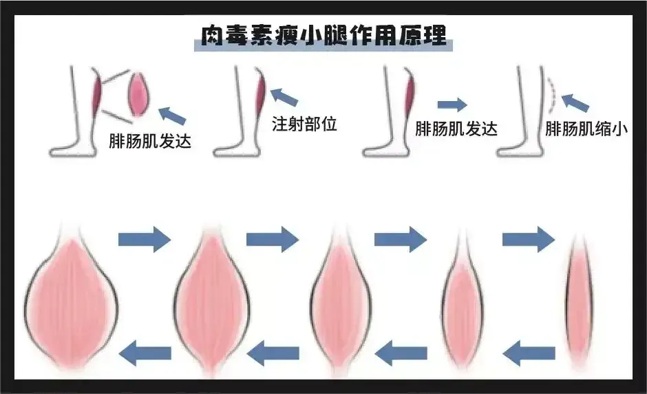 大腿吸脂案例