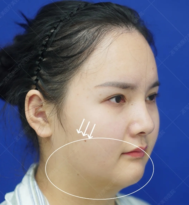 发腮如何改善