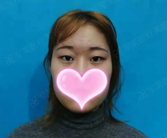单眼皮如何变成双眼皮
