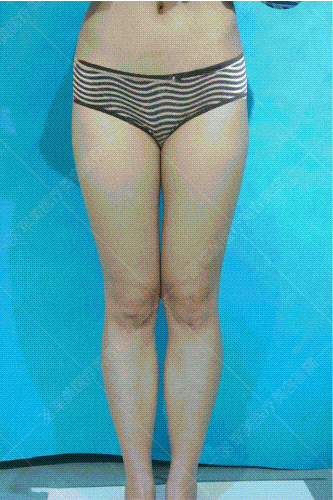 吸脂术后会不会留疤