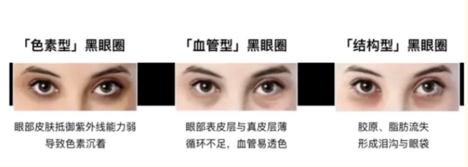 黑眼圈的形成原因