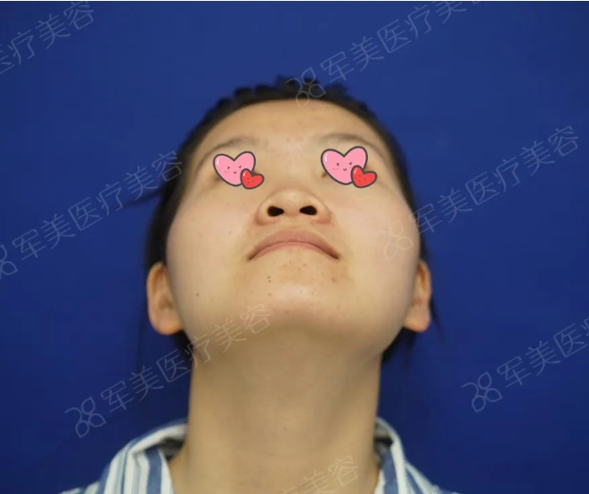 鼻头大怎么改善