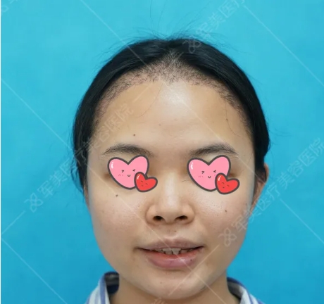 朝天鼻如何改善