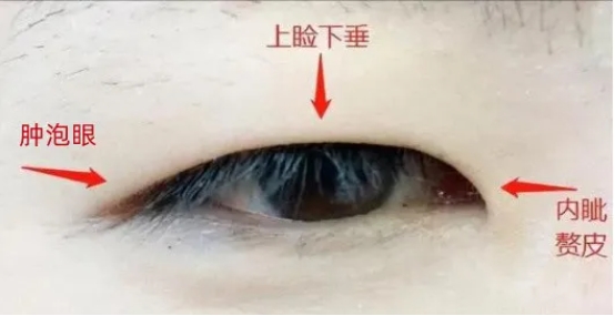 全切双眼皮案例