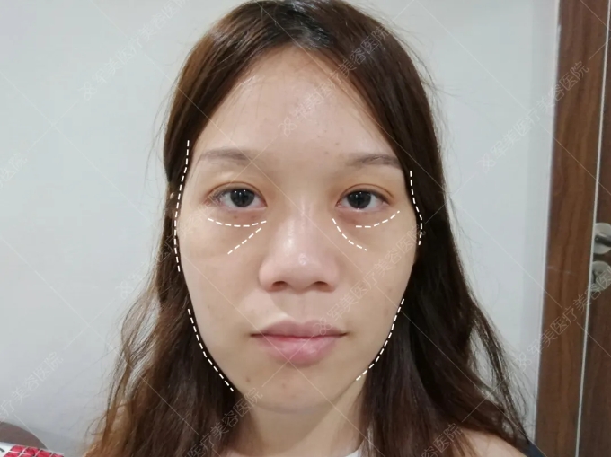 面部凹陷苦相显老怎么改善