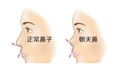 朝天鼻如何改善