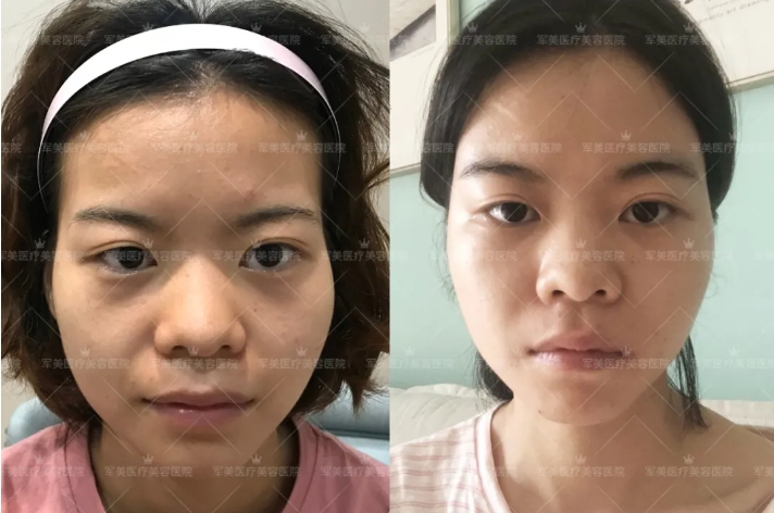广州面部脂肪填充后注意事项有哪些