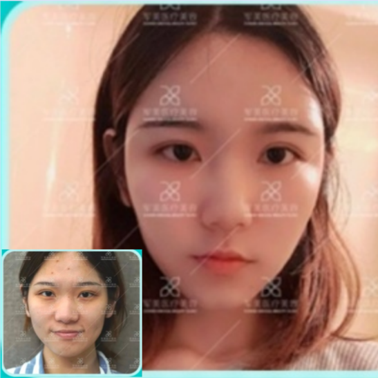 全脸脂肪填充对比图_军美医疗美容医院