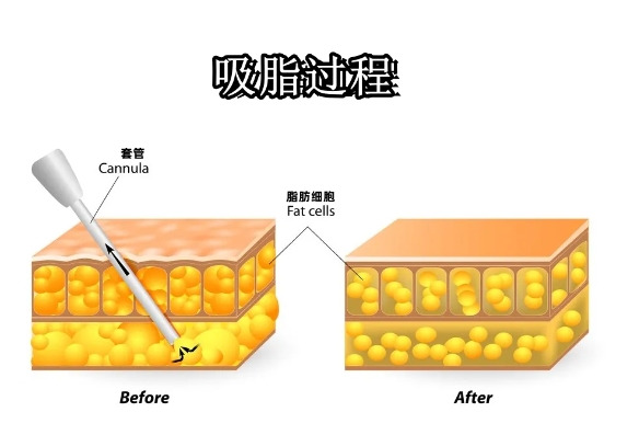 吸脂能瘦多少斤