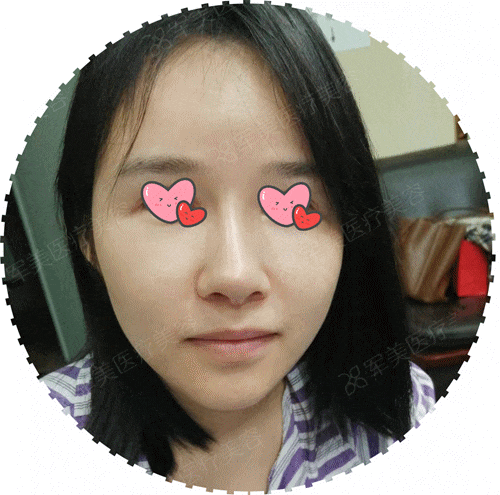 假体隆鼻修复医院哪里好