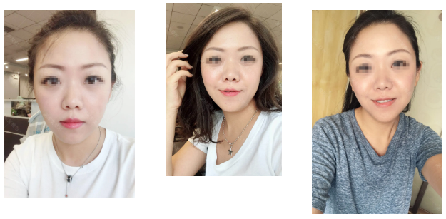 面部抗衰有哪些项目