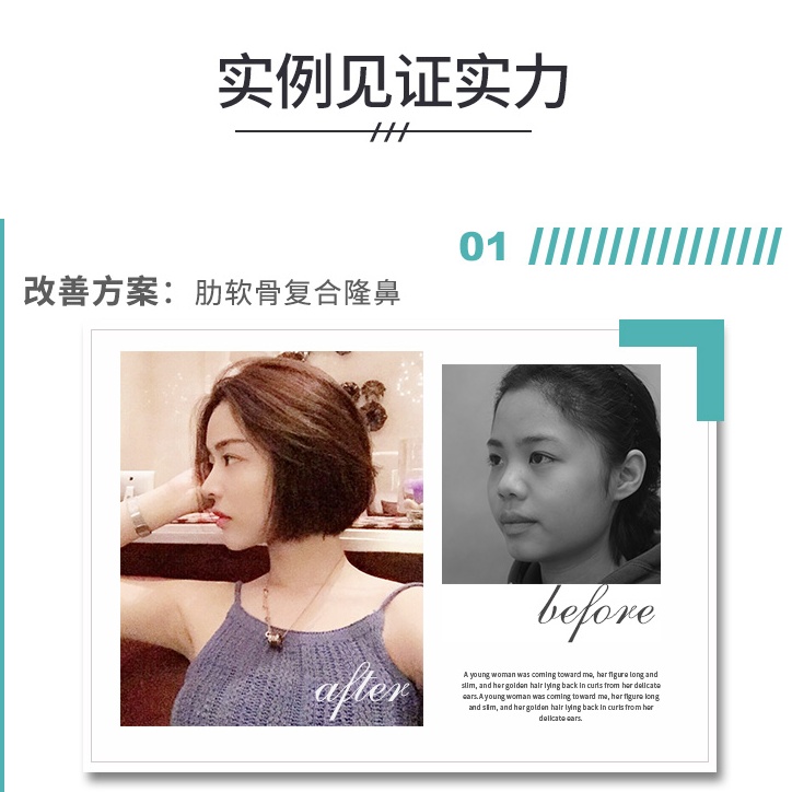 肋软骨隆鼻哪里好？军美肋软骨隆鼻的特性