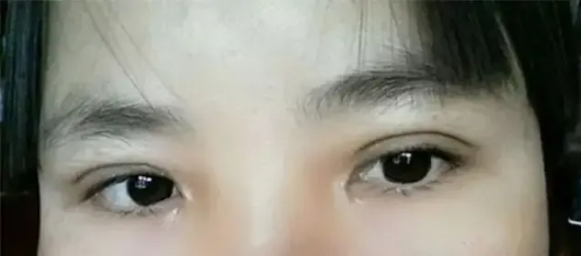 去皮去脂双眼皮案例
