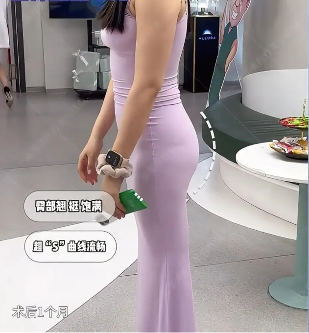 自体脂肪丰臀没效果