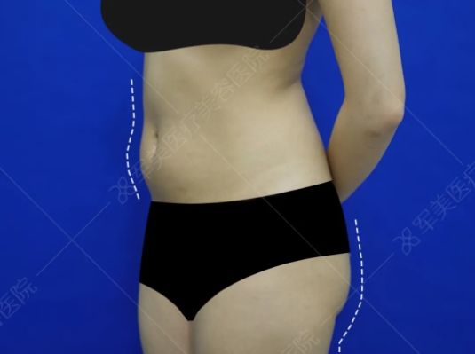 腰腹环吸哪里做得好