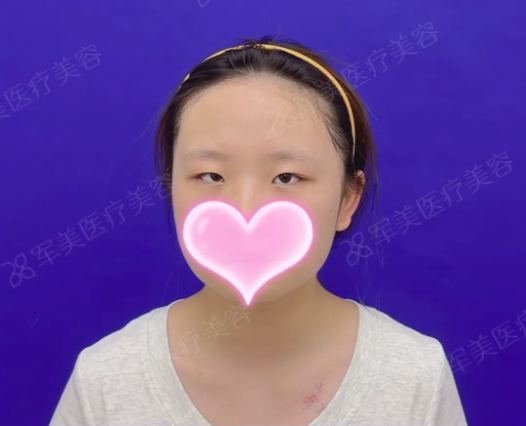 广州医院双眼皮整形