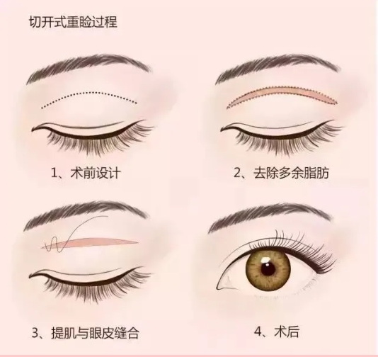 眼睛小割双眼皮能变大吗