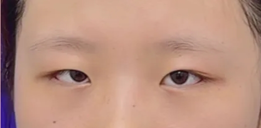 广州医院双眼皮整形