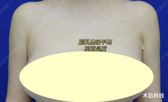 副乳吸脂好还是切除好