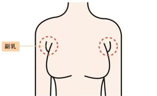 副乳是怎么形成的