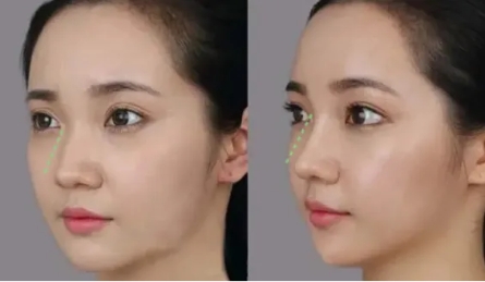 怎么样的鼻子好看