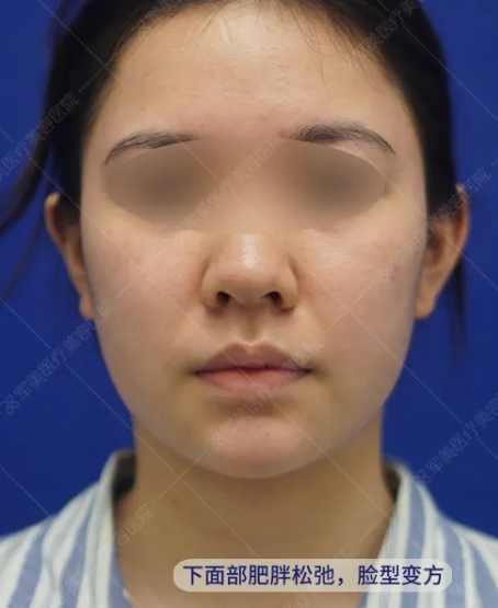 面部发腮的原因有哪些
