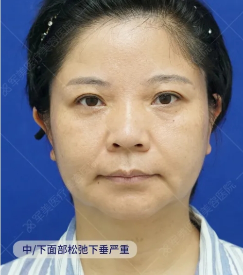 面部发腮的解决方法攻略