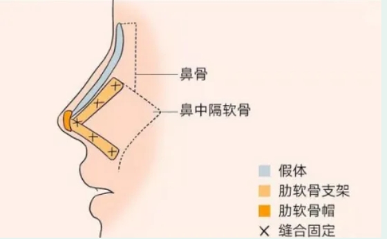 鼻修复的最佳时间