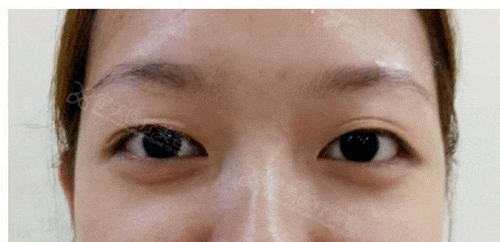 眼周衰老如何改善