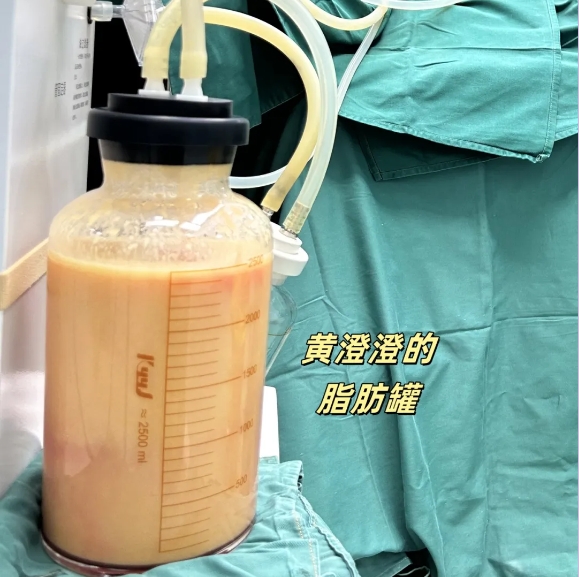 王世虎腰腹吸脂